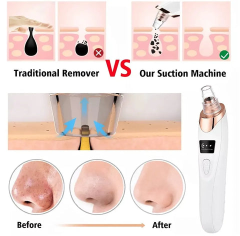 5 in 1 Electric Blackhead Acne Oil Remover Vacuum Suction Face Pore Cleaner Machine